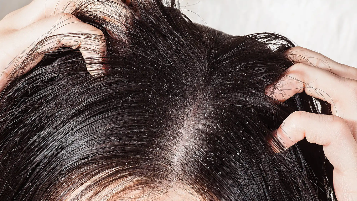 Fokusbild auf einen Kopf mit schwarzen Haaren und Schuppen. | © Adobe Stock/artem_goncharov